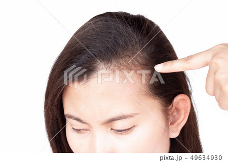 Woman serious hair loss problem for health care 49634930