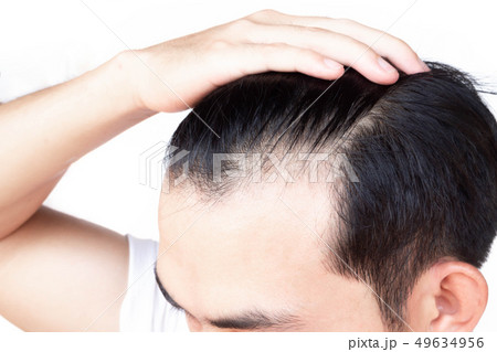 Young man serious hair loss problem for health 49634956