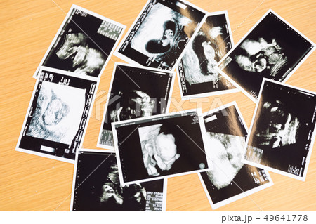 エコー写真 49641778