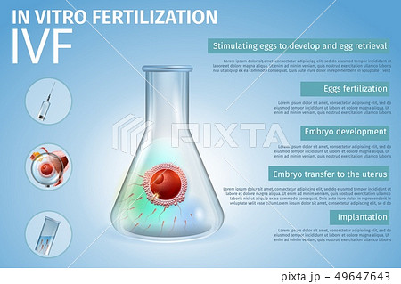 In Vitro Fertilization Stages Process Composition. 49647643