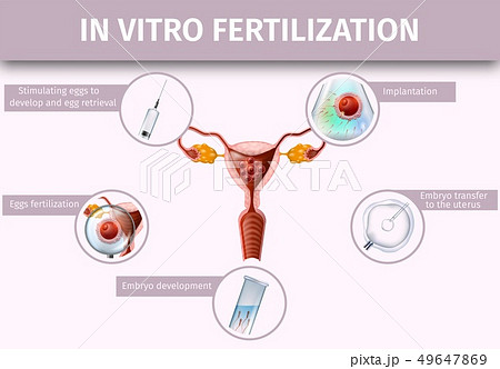 In Vitro Fertilization and Ovulation Background, 49647869