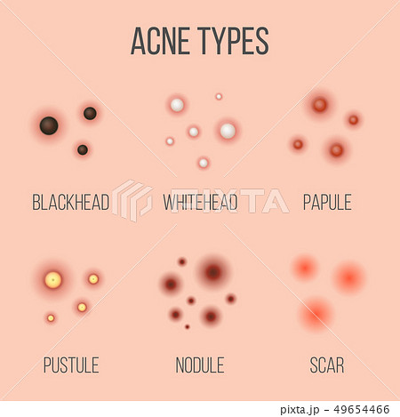 Creative illustration types of acne, pimples, skin pores, blackhead, whitehead, scar, comedone Creative illustration types of acne, pimples, skin pores, blackhead, whitehead, scar, comedone 49654466