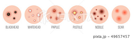 Creative illustration types of acne, pimples, skin pores, blackhead, whitehead, scar, comedone 49657457