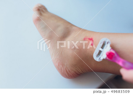 The leg is wound with bleeding caused by scratching. 49683509