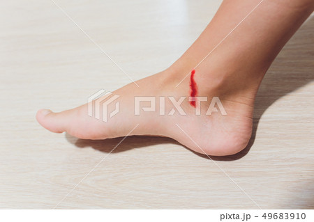 The leg is wound with bleeding caused by scratching. 49683910