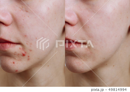 Young woman before and after acne treatment, closeup. Skin care concept 49814994