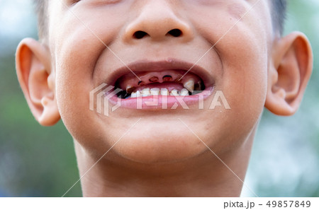 Boy or children have problem teeth about caries Boy or children have problem teeth about caries 49857849