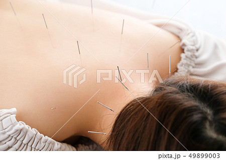 明るい鍼灸院で針を背中に刺される女性	 49899003