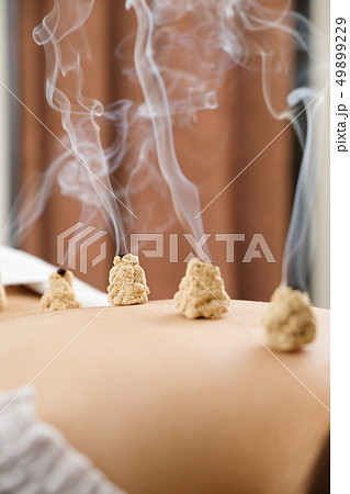明るい鍼灸院で女性の背中に置かれた煙が出ているお灸	 49899229