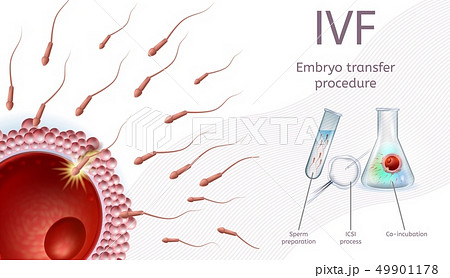 In Vitro Fertilization Embryo Transfer Procedure. 49901178