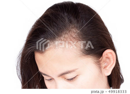 Woman serious hair loss problem for health care 49918333