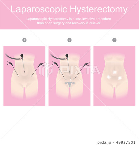 Laparoscopic hysterectomy is a less invasive 49937501