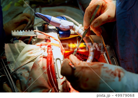 Heart surgery. Open heart surgery suture greater Heart surgery. Open heart surgery suture greater 49979068