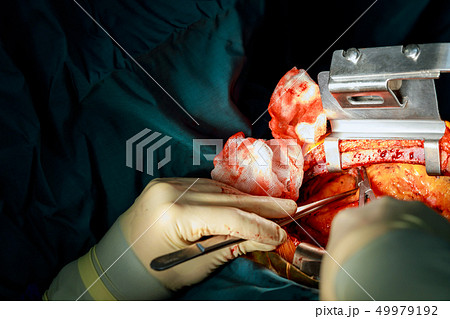 Surgery for coronary artery disease using off-pump 49979192