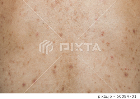 Boy with problematic skin and acne scars in back Boy with problematic skin and acne scars in back 50094701
