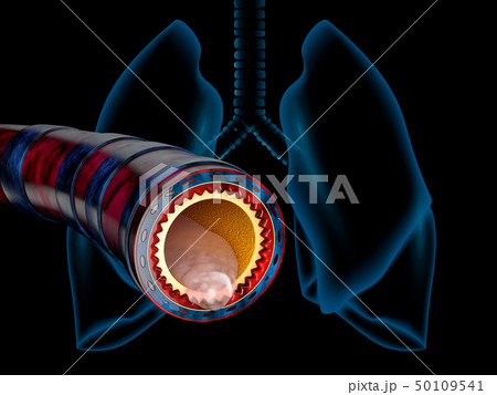 Bronchitis anatomy, mucus secreted as a chest cold as a 3D illustration 50109541