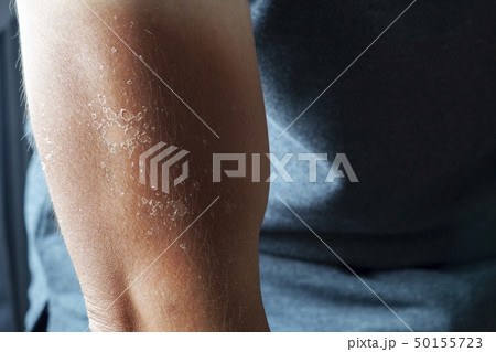 SunBurn Arm, Unhealthy Skin Burnt Peeling SunBurn Arm, Unhealthy Skin Burnt Peeling 50155723