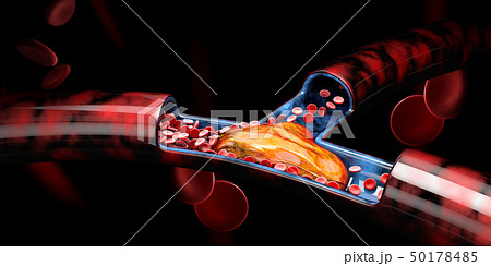 3d Illustration of Deep Vein Thrombosis or Blood Clots, Embolism. 50178485