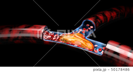 3d Illustration of Deep Vein Thrombosis or Blood Clots, Embolism isolated black 50178486