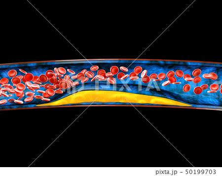3d Illustration of blood cells with plaque buildup of cholesterol 50199703