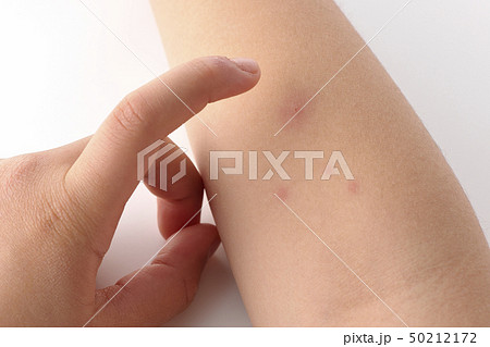 水疱瘡 水痘 みずぼうそう 水疱瘡 水痘 みずぼうそう 50212172