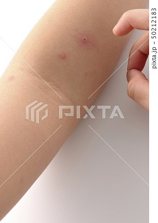 水疱瘡　水痘　みずぼうそう 50212183