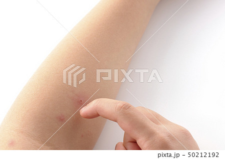 水疱瘡　水痘　みずぼうそう 50212192