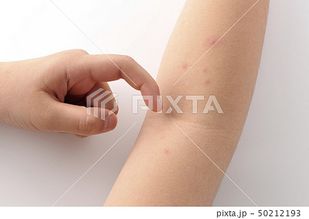 水疱瘡　水痘　みずぼうそう 50212193