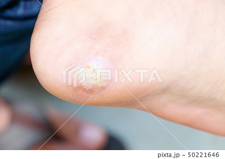 close up pain foot corn close up pain foot corn 50221646