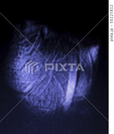 MRI knee meniscus tear scan MRI knee meniscus tear scan 50225812