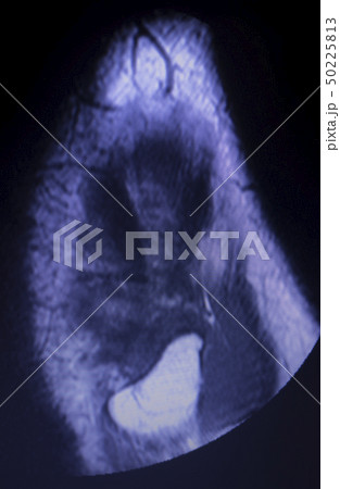 MRI knee meniscus tear scan MRI knee meniscus tear scan 50225813