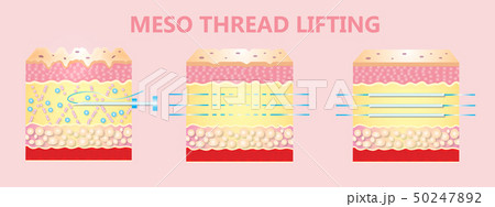 illustration of meso threads lifting 50247892