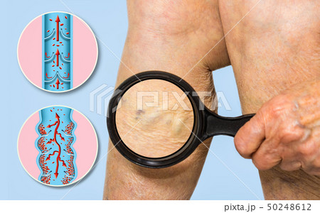 Varicose veins on a female senior legs. The Varicose veins on a female senior legs. The 50248612