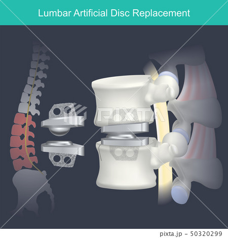 Lumbar Artificial Disc Replacement. Lumbar Artificial Disc Replacement. 50320299