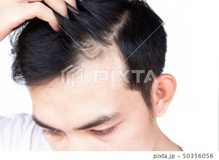 Young man serious hair loss problem for health  50356056