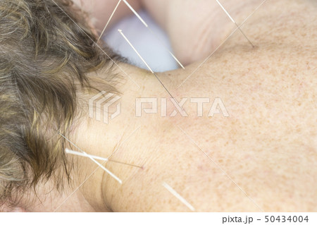 Elderly woman undergoing acupuncture procedure in  50434004