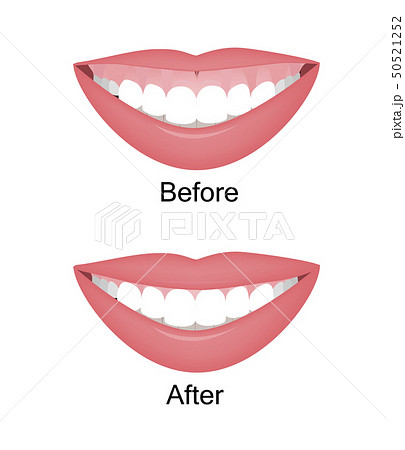 Mouth with a high smile line or gummy smile before and after the orthotropics, orthotropics or botox Mouth with a high smile line or gummy smile before and after the orthotropics, orthotropics or botox 50521252