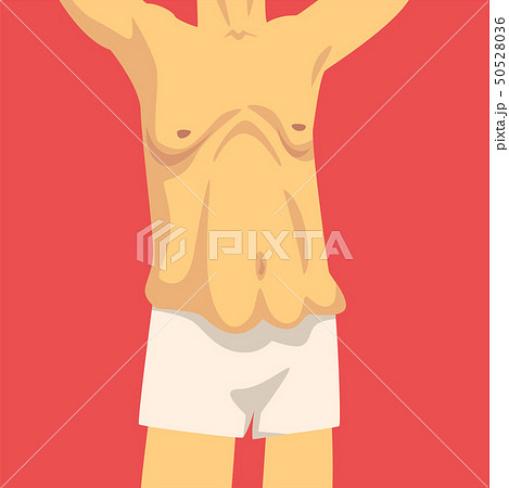 Male Torso with Sagging Belly, Human Body After Weight Loss, Front View, Obesity and Unhealthy 50528036