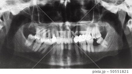 human jaws with dental crown and pins in teeth 50551821