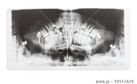 film with X-ray image of human jaws isolated 50551829
