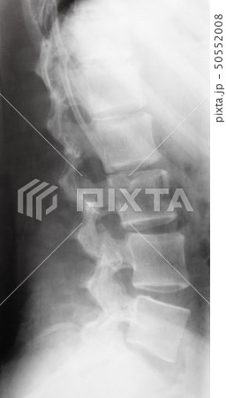 view of human spine on X-ray image 50552008