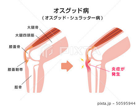 オスグッド病（オスグッド・シュラッター病）図解イラスト 50595944