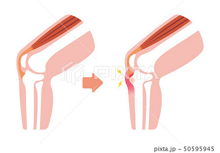 オスグッド病 オスグッド シュラッター病 図解イラスト 文字なし のイラスト素材