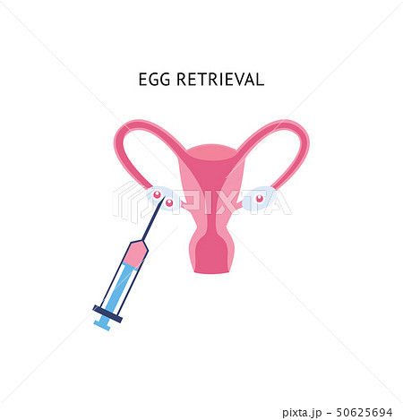 Female egg retrieval for fertilization Female egg retrieval for fertilization 50625694