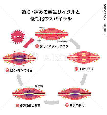 肩こり 凝り 痛みの発生サイクルと慢性化プロセス イラストのイラスト素材