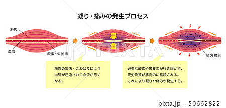 肩こり 凝り 痛みの発生プロセス イラスト 解説文付きのイラスト素材