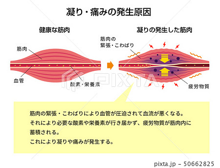 肩こり(凝り)・痛みの発生原因イラスト/解説文付き 肩こり(凝り)・痛みの発生原因イラスト/解説文付き 50662825
