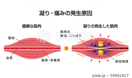 肩こり 凝り 痛みの発生原因イラストのイラスト素材