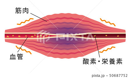 血流の悪化により酸素 栄養不足になった筋肉 肩こり 凝り 痛みの発生イラストのイラスト素材