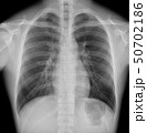 胸部レントゲン　正面 50702186